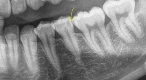 Befund: versteckte Zwischenraum-Caries am Backenzahn