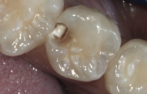  minimal-invasive<br />
Caries-Entfernung