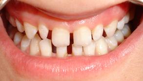 Veneers (vorher)