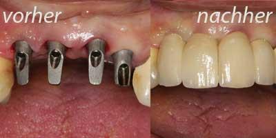 Zahnimplantation vorher/nachher