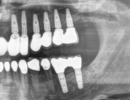 Röntgenbild eines Zahnimplantats