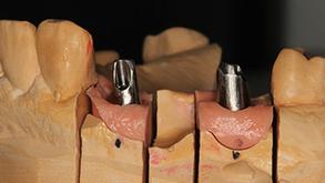 Zahntechnik für Zahnimplantate