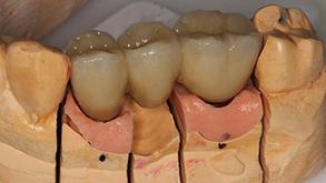 Zahnersatz auf Zahnimplantaten (Implantatprothetik)
