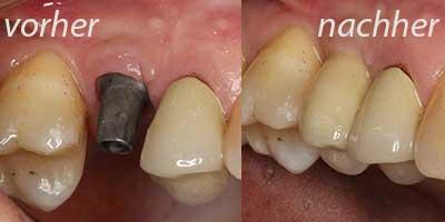 Zahnimplantation vorher/nachher