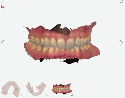 Abdruckfreie Behandlung ohne Würgereiz