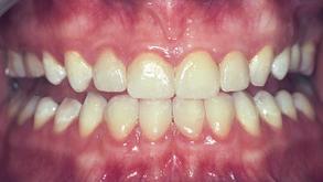 Veneers (nachher)